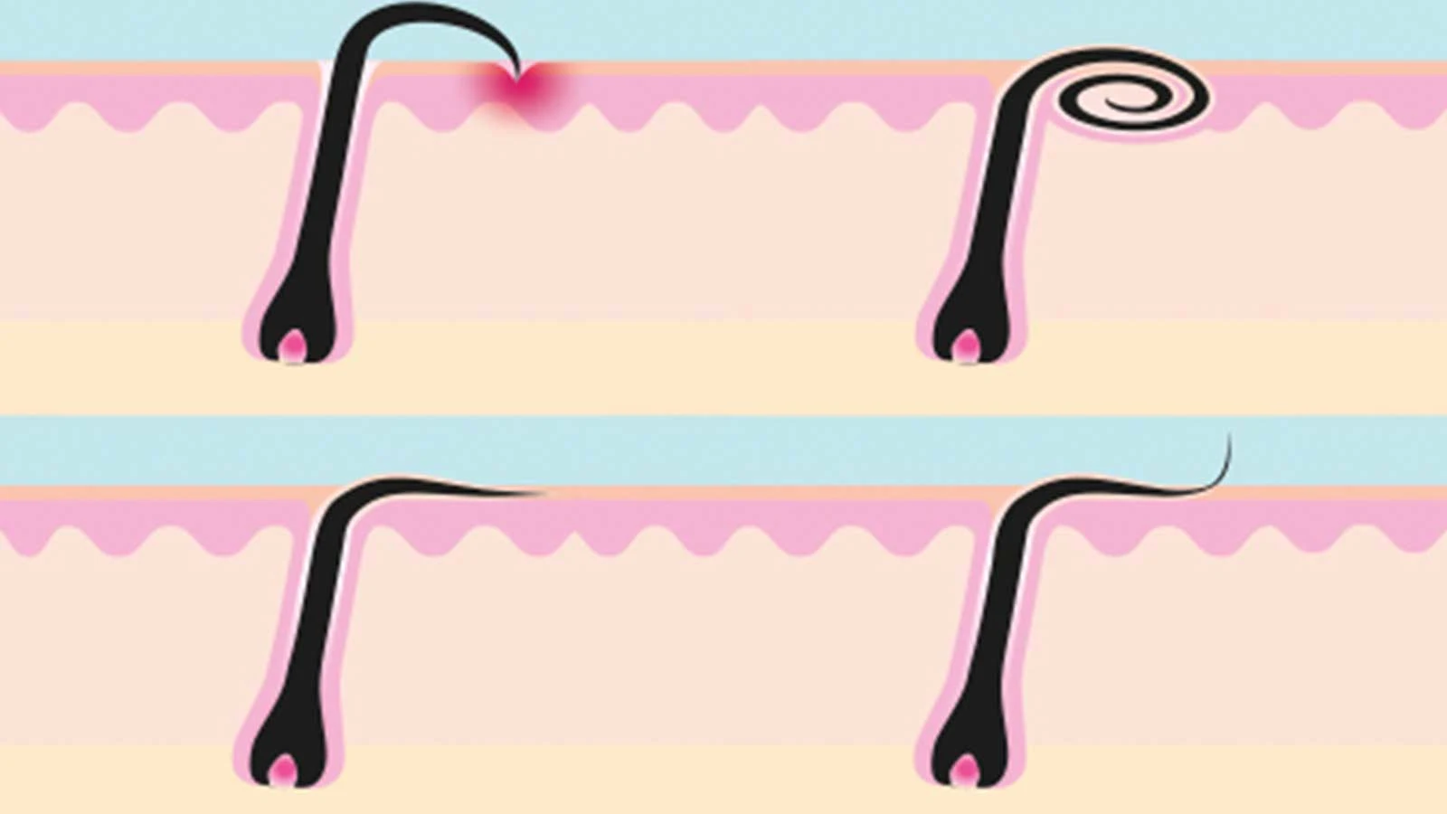 Illustrations of three types of ingrown hairs