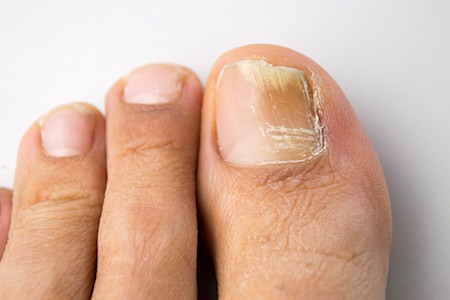 Nail fungus has caused buildup beneath the nail and the nail to lift up.