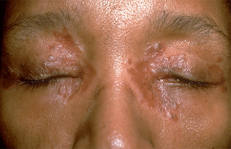 Woman with tiny, smooth bumbs of sarcoidosis on face