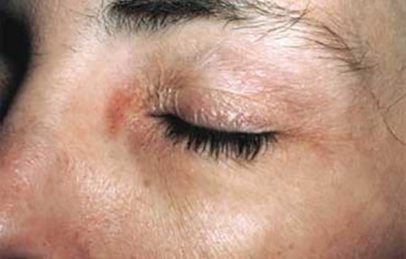 Contact dermatitis on eye