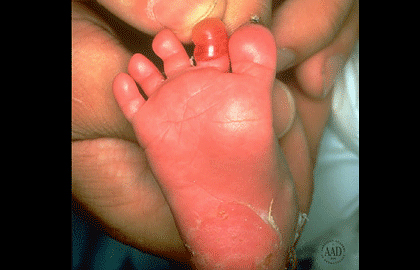 Epidermolysis bullosa simplex causes blistering on the foot of a newborn