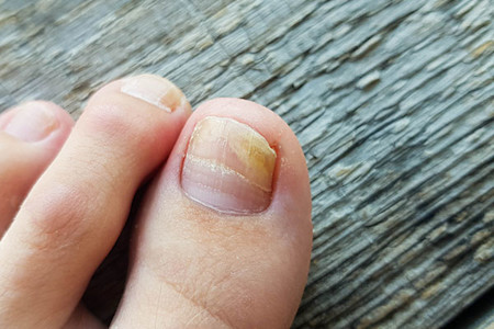 Nail fungus caused the discolored nail, lifting, and redness on the skin around the nail.