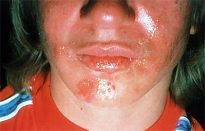Cold sore outbreak triggered by this teenager's serious sunburn