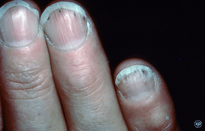 Red or purple lines under nails