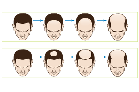 How male-pattern hair loss progresses