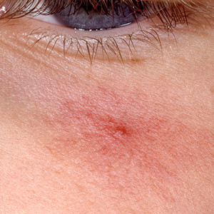 Card image of a spider angioma on a lighter skin tone for a DWII about topical timolol treatment | American Academy of Dermatology (AAD)