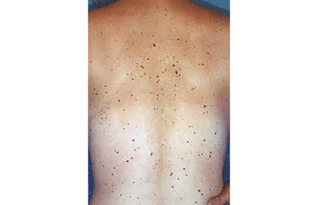 50-plus moles on the back of a man