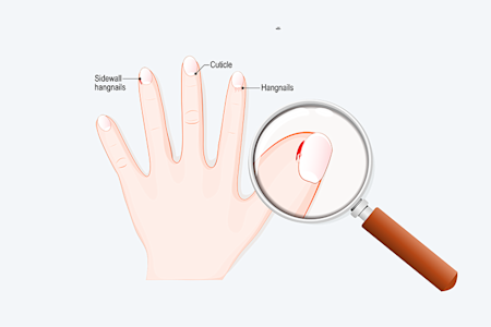 Hangnail illustration for kids' section
