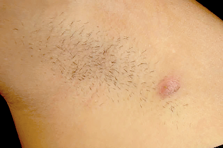 Tender, deep nodule in armpit caused by hidradenitis suppurativa