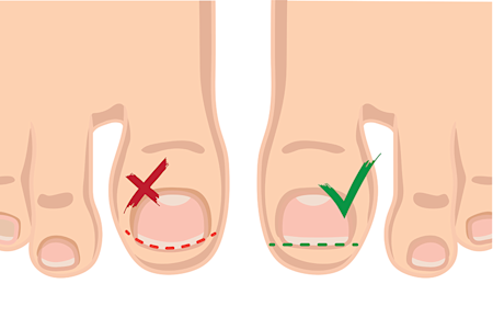 Illustration of a correct way to cut toe nails