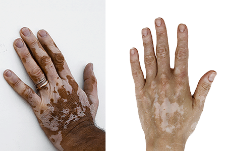 Vitiligo on hand of Black person and hand of white person