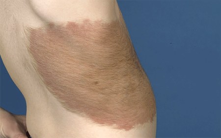 Large mole on a 4-year-old boy