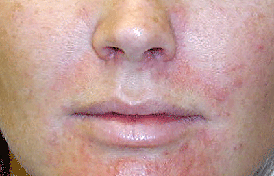Woman with perioral dermatitis