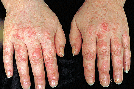 Hives cover woman’s hands.