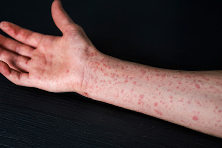 Image for Measles resources help dermatologists manage outbreak