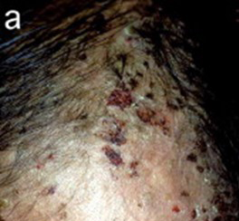 Card illustration for DWII on Rituximab-induced late onset neutropenia