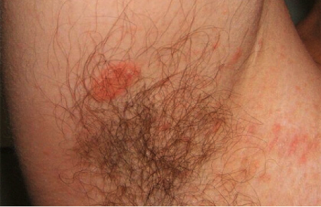 Pityriasis rosea on man's underarm
