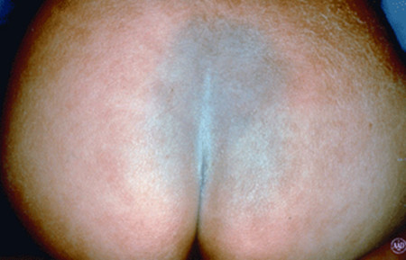 Mongolian spot on buttocks