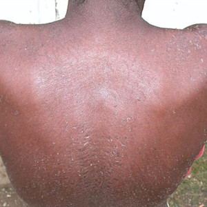 Card image for DWII of a man with scaly skin induced by kava