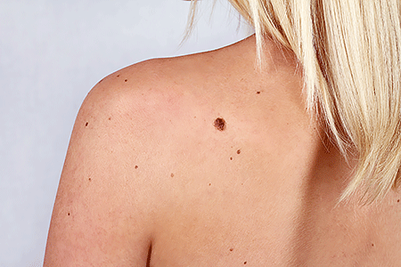 Young woman with a birthmark on her back, skin. Checking skin on body for moles.