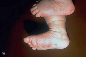 Baby with scabies on feet
