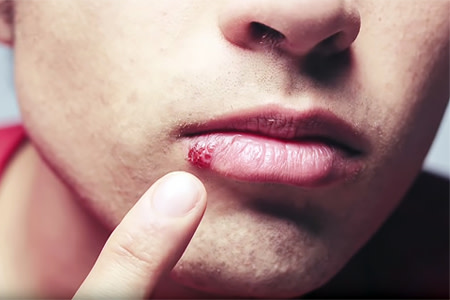 Patient pointing to cold sore on lip