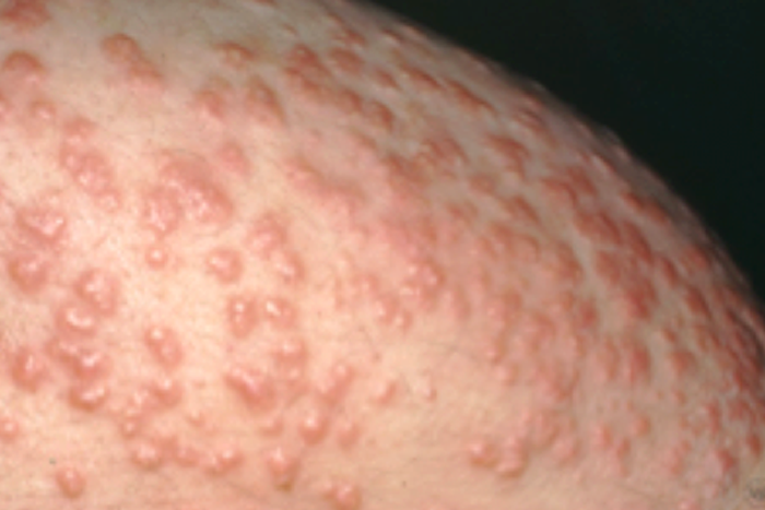Eruptive xanthomatosis bumps can often look like pimples