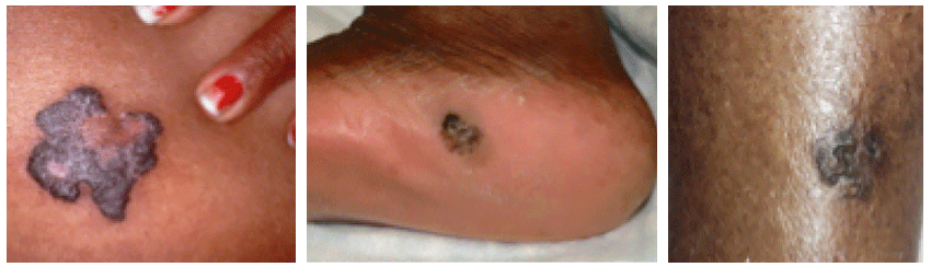 Skin cancer in people with brown or black skin
