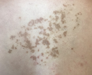 Card image for DWII Prurigo pigmentosa as the “keto rash”: I’m a believer