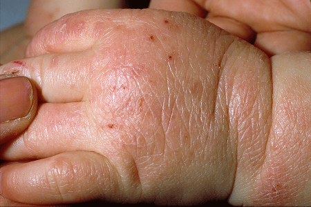 Dry, scaly skin on baby’s hand due to atopic dermatitis