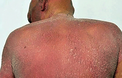 Sézary syndrome can cause widespread redness