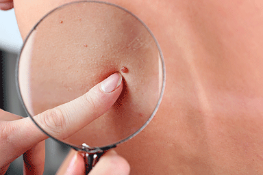 A dermatologist examining a pimple-like growth on a patient