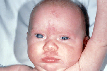 A baby with a salmon patch birthmark on face