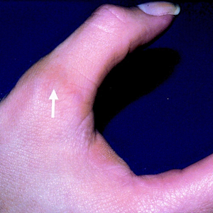 Card illustration for DWII on palmar Pagetoid dyskeratosis