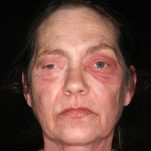 Card image of uveal melanoma for DWII