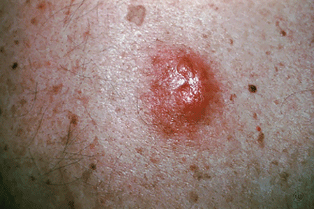 Close-up of a melanoma that looks like a cyst