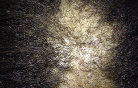 Close-up of scarring on scalp