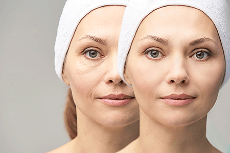 Before and after portrait of a woman who has had a filler treatment.