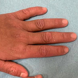 Card image for DWII on Chanarin-Dorfman syndrome