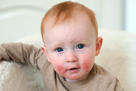 Baby with itchy atopic dermatitis rash on his face
