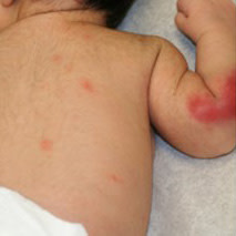 Image for subcutaneous fat necrosis of the newborn and hypercalcemia