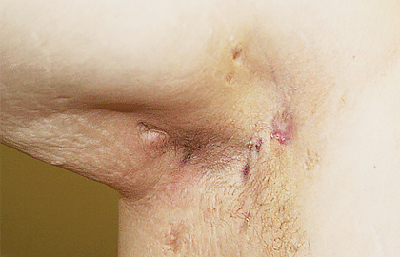 Underarm of man with hidradenitis suppurativa