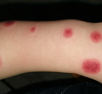 Card illustration for DWII on acute hemorrhagic edema of infancy