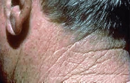 Rough-feeling patch of skin on back of a man's neck is a symptom of actinic keratosis