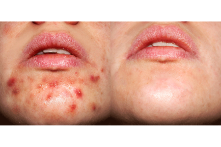 Before and after having acne treated by a dermatologist