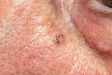 Pinkish basal cell carcinoma near patient’s eye has a raised border, which contains some spots of brown | American Academy of Dermatology