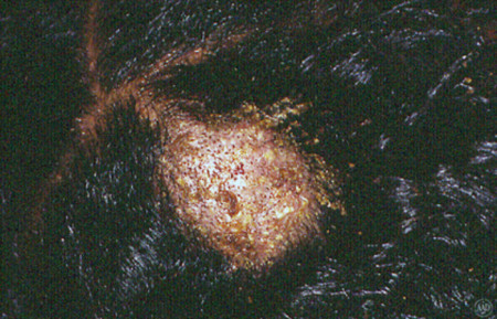 Close-up of African American girl's scalp with ringworm