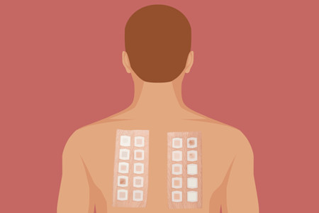 Experts discuss techniques for the diagnosis and treatment of allergic contact dermatitis.
