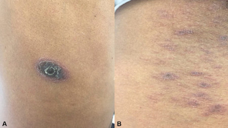DWII card illustration for ibrutinib