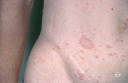 Pityriasis rosea light herald patches